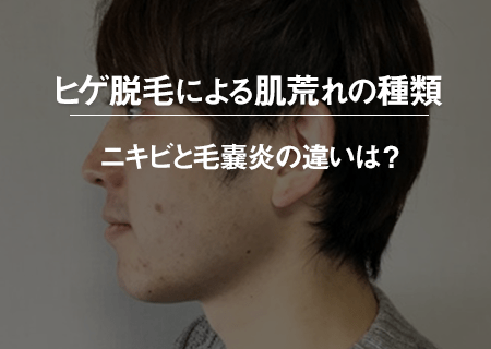 ヒゲ脱毛による肌荒れの種類