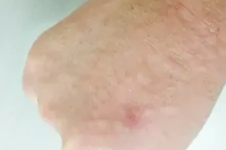 ヒリヒリした痛み・むくみ → 炎症性浮腫