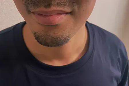 ヒゲ脱毛は痛い？結論から言うと「対策すれば耐えられる」