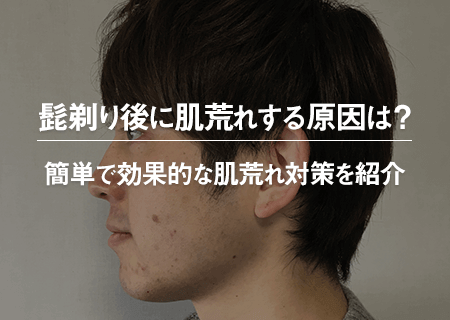 髭剃り後に肌荒れする原因と簡単なのに効果的な5つの肌荒れ対策