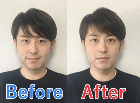メンズコンシーラーの青髭への効果を写真で比較