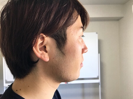 目立っていた青髭を少し薄くすることができました