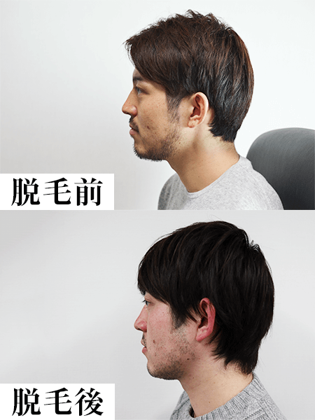 クリニックのレーザー脱毛1回目の効果-脱毛前