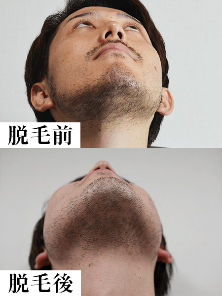 クリニックのレーザー脱毛1回目の効果-脱毛後